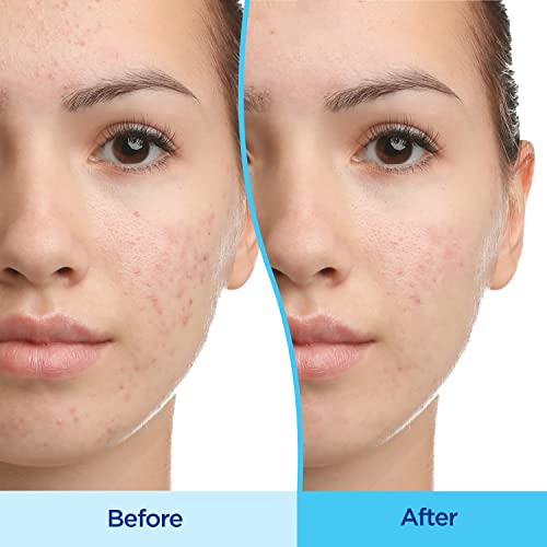 Differin Acne Treatment Gel, 30 Day Supply, Retinoid Treatment for Face with 0.1% Adapalene, Gentle Skin Care for Acne Prone Sensitive Skin, 15g Tube - Image 3