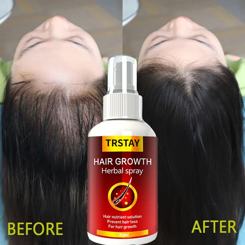 Hair Growth Serum Spray Fast Hair Growth Liquid Treatment Scalp Hair Follicle Anti Hair Loss Natural Beauty Health Hair Care - Image 4